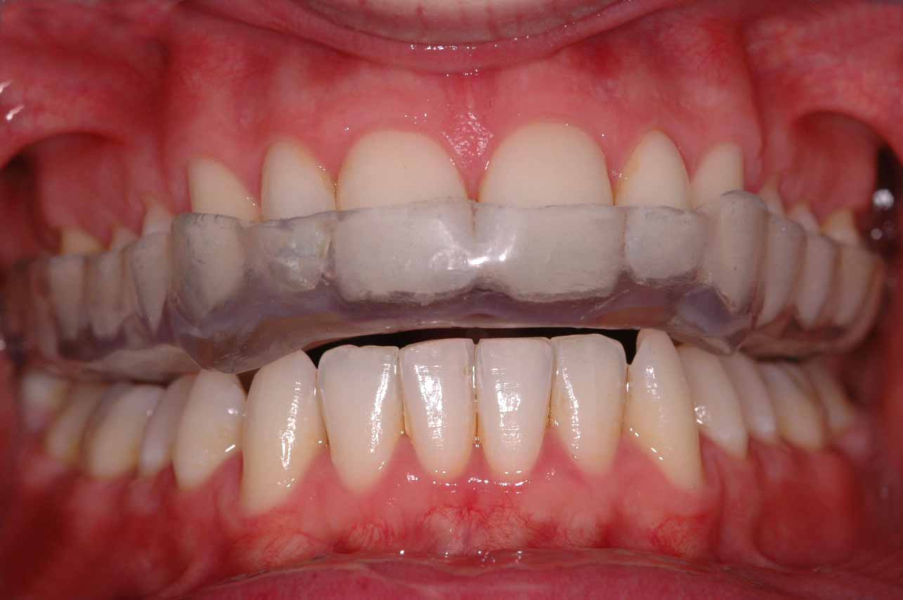 Appareil dentaire de nuit : à quoi sert une gouttière ?