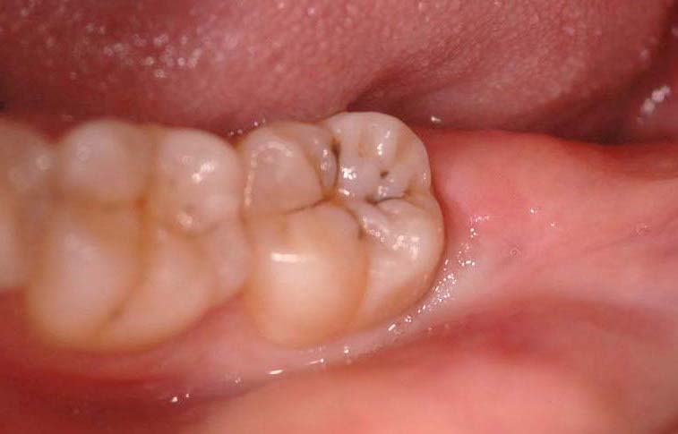 extraction dent de sagesse incluse : le jardin des dents !