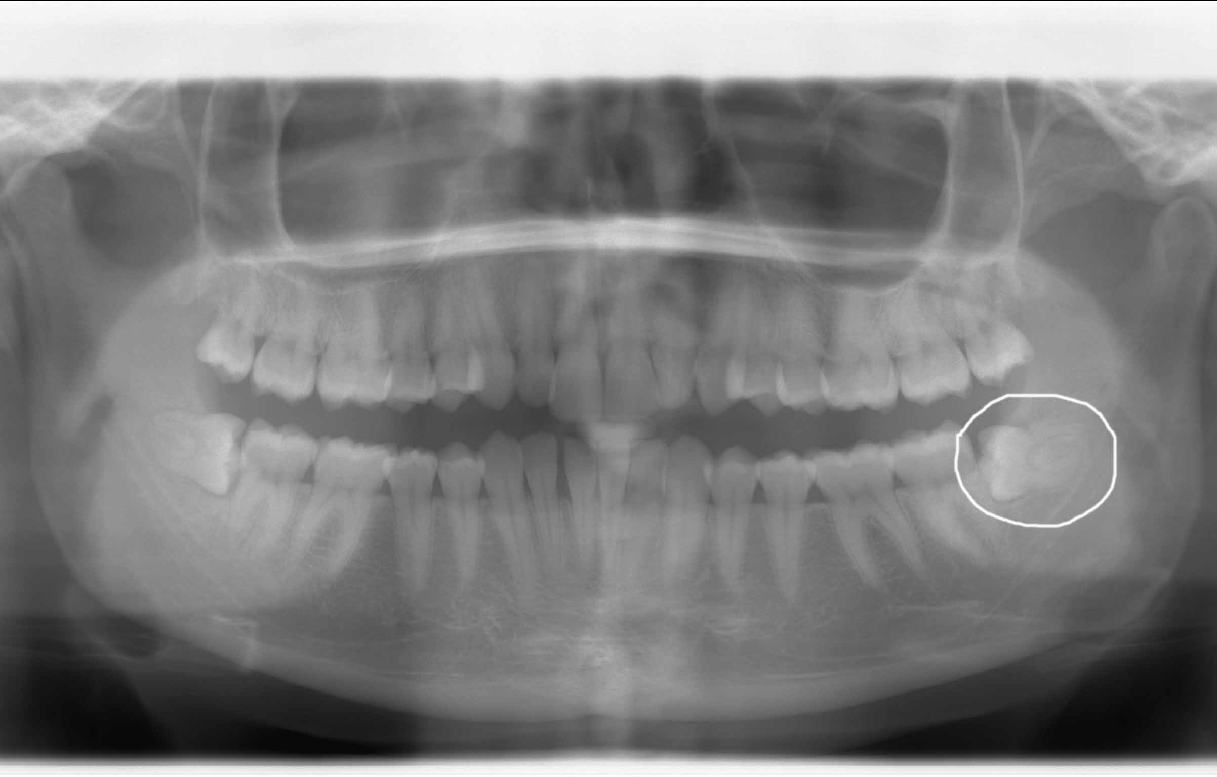 Extraction de dents incluses, Cabinet dentaire Massena